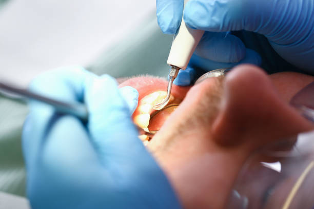 Best Emergency Tooth Extraction in Dunlap, IN